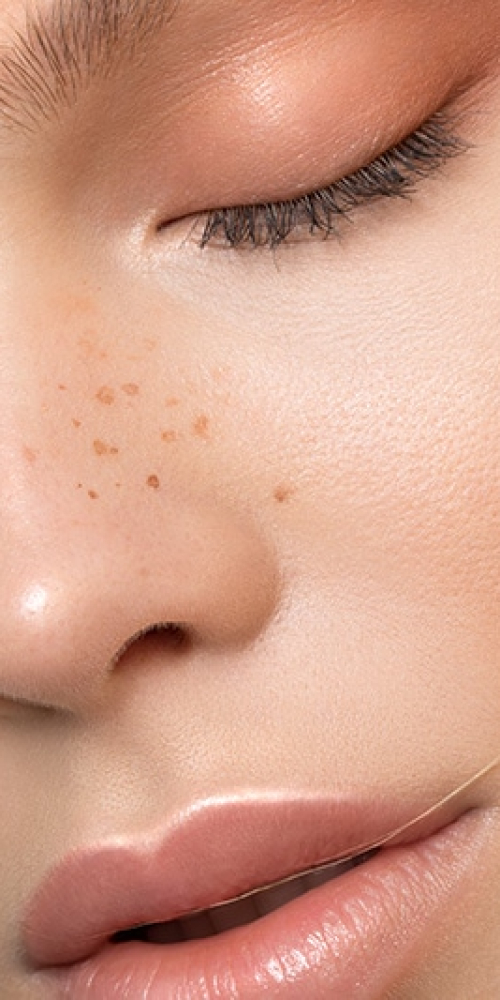 laser-freckle-middle